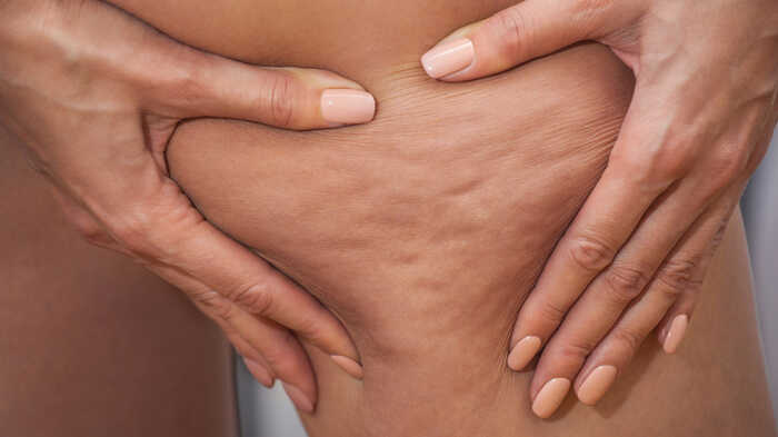 woman with cellulite on the back of her thighs woman with cellulite on the back of her thighs